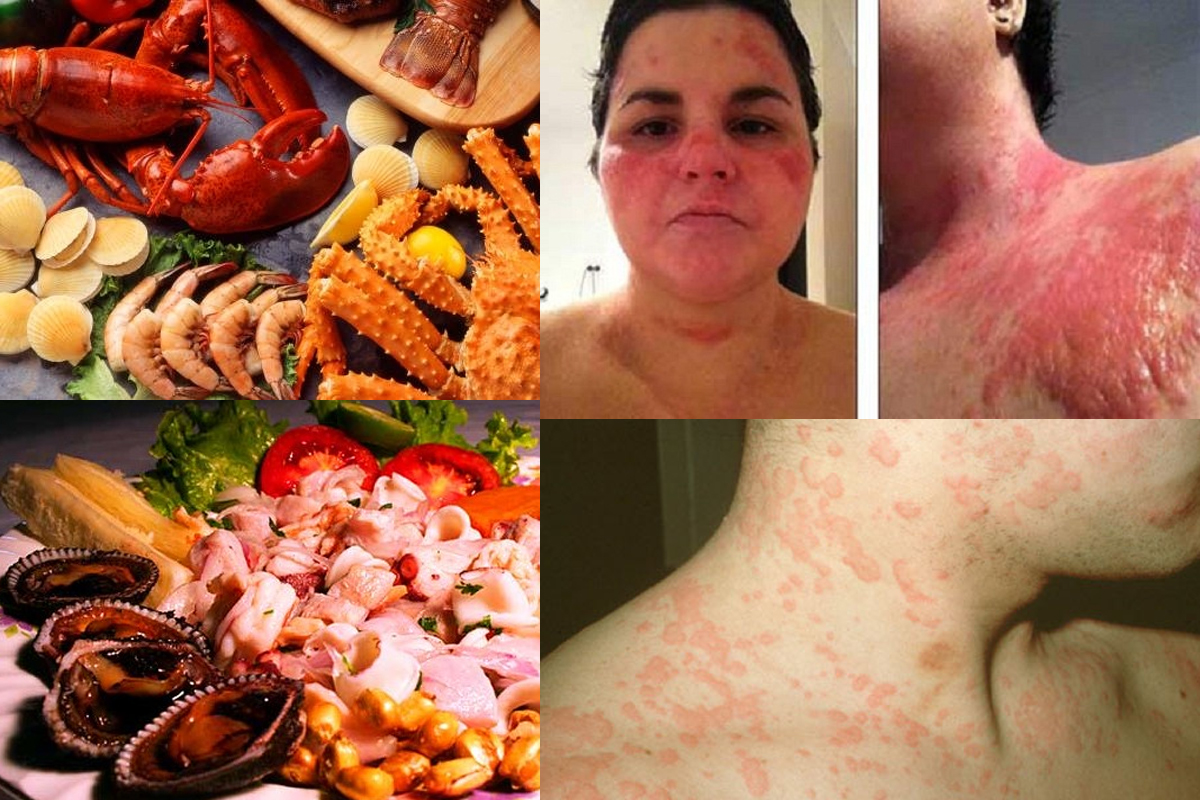 Vì Sao Cá Nước Ngọt Ít Gây Dị Ứng Hơn Hải Sản?